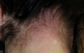 Hair dye allergy where bumps or hives are forming at the back of the neck and below the hairline.